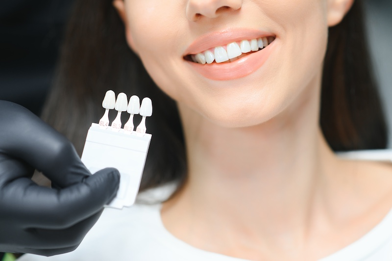 Dental veneers in Indianapolis
